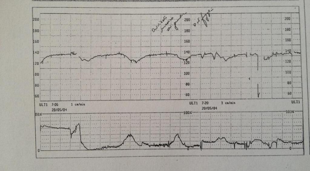 analysis of tracing late decelerations