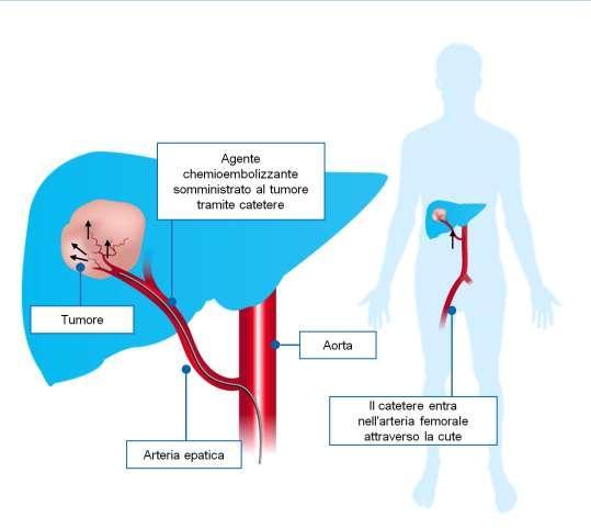 Embolizzazione e Chemoembolizzazione L embolizzazione transarteriosa (TAE) blocca l apporto ematico alle metastasi epatiche La chemomioembolizzazione transarteriosa (TACE) prevede: - Embolizzazione -