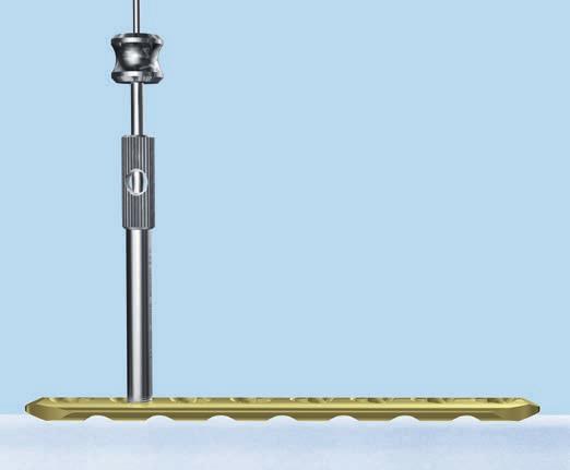 5 Opzione: Inserimento del filo di Kirschner Strumenti Frammento piccolo 323.055 Centrapunte per filo di Kirschner da Ø 1.6 mm oppure 324.081 Centrapunte per filo di Kirschner da Ø 1.25 mm 292.120.