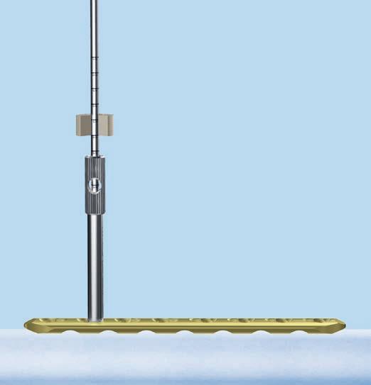 Inserimento delle viti di bloccaggio autofilettanti 6 Praticare il foro per la vite Strumenti Frammento piccolo 310.284 Punta elicoidale LCP da Ø 2.8 mm Frammento grande 310.