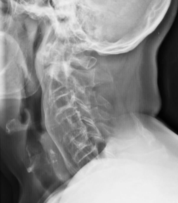 ESAMI STRUMENTALI Esegue come primo esame radiologico una radiografia del rachide cervicale.