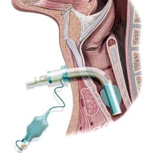 Introduzione La tracheotomia (TS) è un accesso chirurgico fra trachea e cute, confezionato con atto operatorio per consentire l ingresso dell aria direttamente nei bronchi e nei polmoni, senza