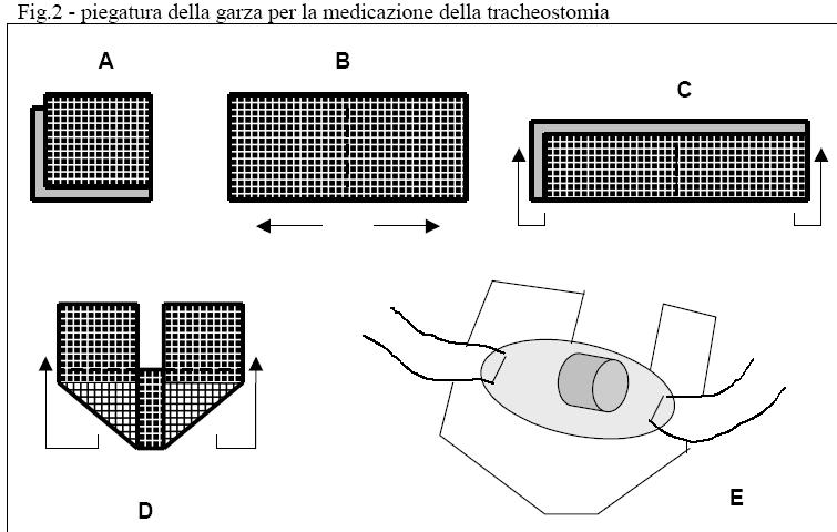 12 mettere la garza sterile (garza metallina o garza TNT pretagliata) intorno alla cannula, se metallica con la parte metallica rivolta verso la cute; 13.