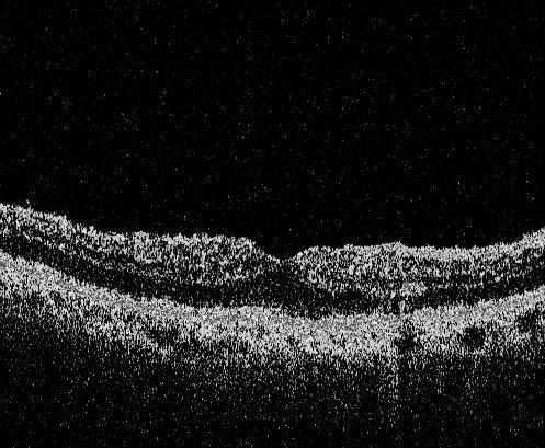 ANGIOGRAFIA A FLUORESCENZA (FAG) L iniezione rapida di 5 cc di fluoresceina sodica provoca l arrivo di un vero embolo di questa sostanza a livello dell arteria oftalmica.
