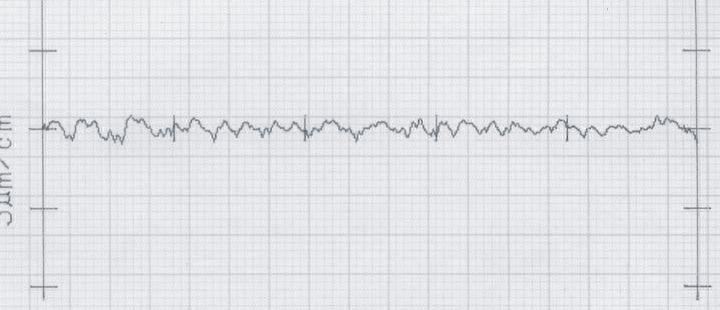 000 mm/min cus un rottur dell fres frontle test semisferic. Con un fres MIACLE OBIT, l lunghezz di tglio di 00 m può essere rggiunt con un grdo di usur minimo.