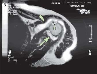 Trochanteric bursitis With sensitivities and specificities of more than 90% US is less