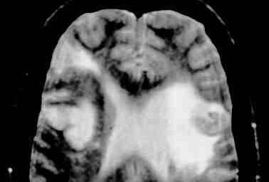 Infarto cerebrale RMI Indici di mortalità cardio-cerebro-vascolare 1.