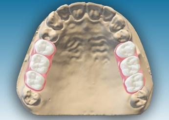 Wax-up senza monconi Questo tipo di protesi consente di aggiungere un wax-up al vostro caso senza doverlo vincolare ad un margine.