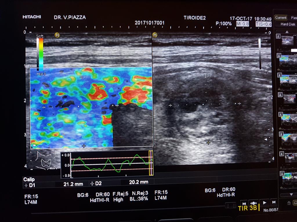 NODULO TIR 3B IN FOLLOW UP DA 3 ANNI BIOGRAFIA 1) Ultrasound elastography for thyroid nodules: recent advances - Jin Young Kwak, Eun-Kyung Kim Department of Radiology, Research Institute of