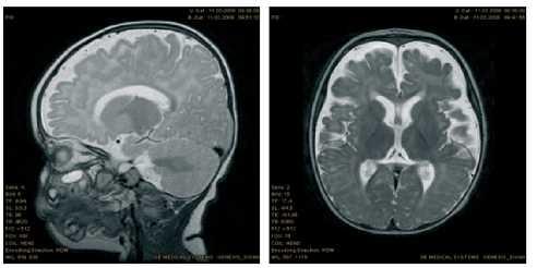 Diagnosi strumentale EFFETTI NEUROTOSSICI Atrofia corticale Ritardo mielinizzazione Ipoplasia corpo calloso Moderato allargamento ventricoli Anormalità gangli