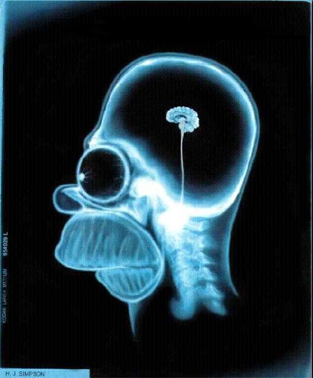 MRI vs.
