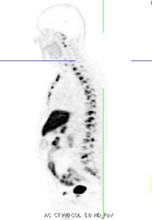 ipsa: 131 ng/ml; GS 4+4; Stadio clinico: ct4 N0M1b Terapia: LH-RH analogo trimestrale Difosfonati (per 24 somministrazioni totali) Docetaxel (per un totale di 8 cicli) Marzo 2016 Comparsa di dolore