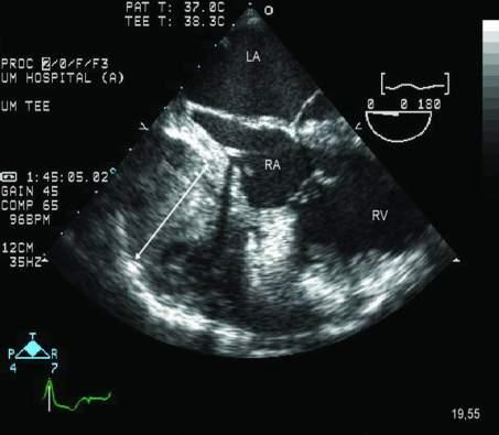 Valutazione con ecocardiografia