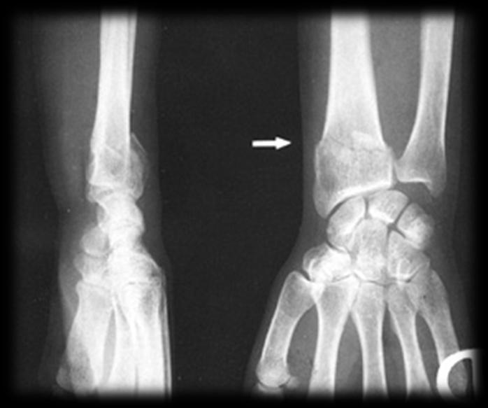 6. Osteoporosi: conseguenze.