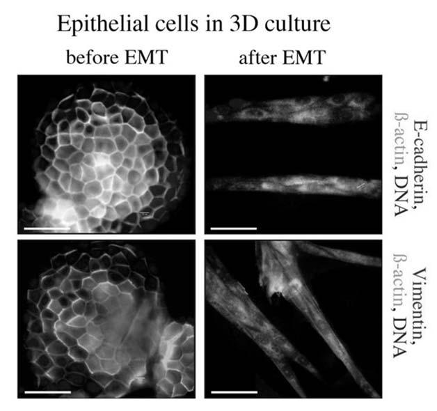 characterized by unorganized structures of fibroblastoid cells expressing no E-cadherin but cytoplasmic