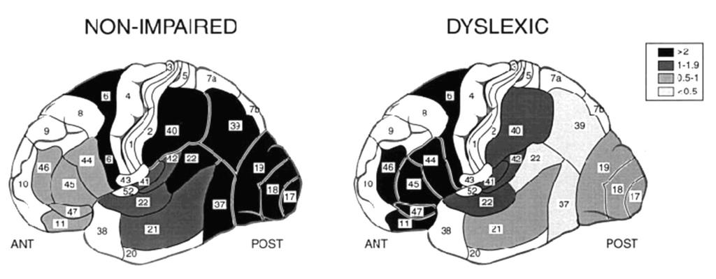 le differenze col normolettore Differenze nelle regioni temporo-parieto -occipitali fra dislessici e
