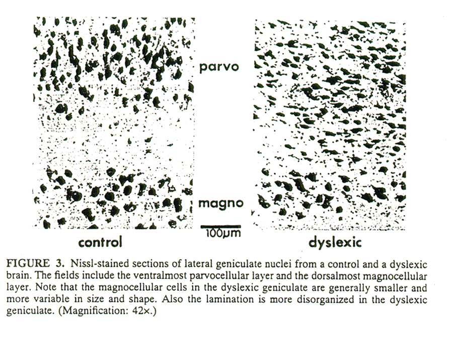 Anomalie strutturali microscopiche Nucleo genicolato laterale: Nei dislessici le cellule dello