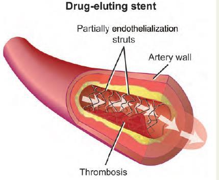 INTRASTENT (mandatory DAPT) =