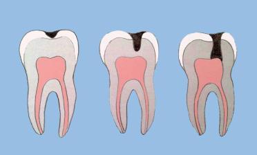 fluoro Puliscilingua Dentifricio Alcuni farmaci usati