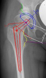 Planning Preoperatorio Standard planning preoperatorio!