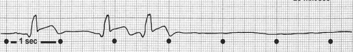 Sincope cardiovascolare Aritmie cardiache come causa primaria Disfunzione del nodo del seno (inclusa la sindrome bradi/tachi) Patologie del sistema di conduzione atrioventricolare Tachicardie