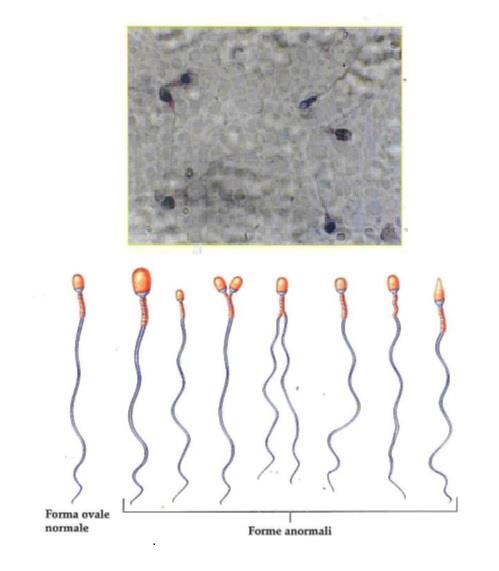 spermatozoi oppure la natura qualitativamente alterata degli spermatozoi (per ridotta motilità, alterata morfologia, DNA danneggiato) che ostacolano il concepimento.
