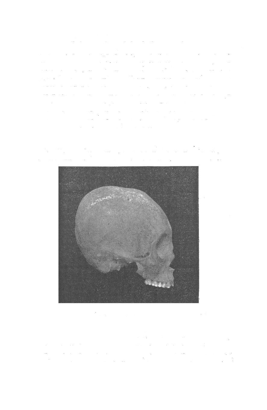 I RILIEVI CEREBRALI BELLE FOSSE TEMPORALI, ECC. 277 sulla volta, una contropressione sull'occipitale e porzione posteriore dei parietali.