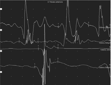 Fisiopatologia: la sofferenza muscolare La sofferenza muscolare neurogena - Reclutamento ridotto delle UM.