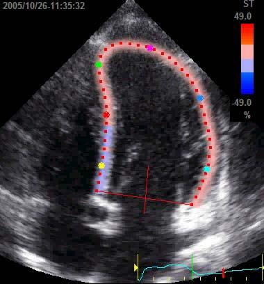 Strain Rate Imaging Lo Strain Rate riflette la velocità di deformazione del tessuto miocardico e può essere misurato tramite ecodoppler