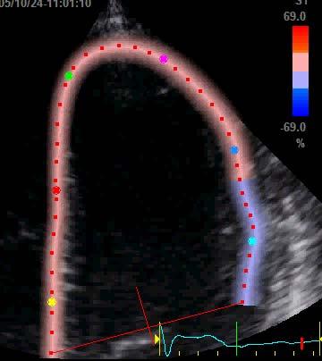 deformazione miocardica Ridotta deformazione di apice e parete laterale miocardica Non essendo condizionato dal movimento dei segmenti adiacenti è