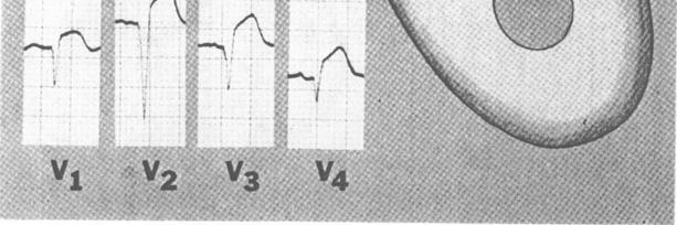 INFARTO