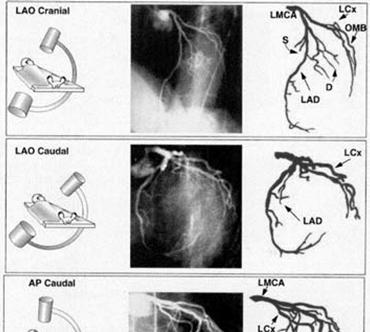 ANATOMIA CHIRURGICA DELLE CORONARIE