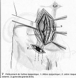 ARTERIA EPIGASTRICA