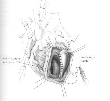 Complicanze dell infarto miocardico