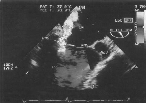 Complicanze dell infarto miocardico Rottura del setto