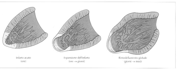 Complicanze dell infarto miocardico Aneurisma Ventricolare sinistro vero Complicanze dell infarto miocardico Aneurisma ventricolare sinistro Nell IMA anteriore è presente una occlusione totale dell