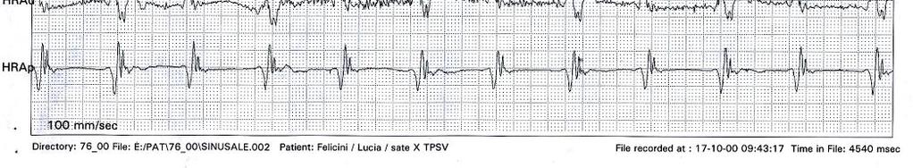 aumentando il Scaricato grado it del blocco AV 74 Flutter Atriale Flutter Atriale Scaricato it 75 Scaricato it 76 Flutter Atriale Cardiopatie