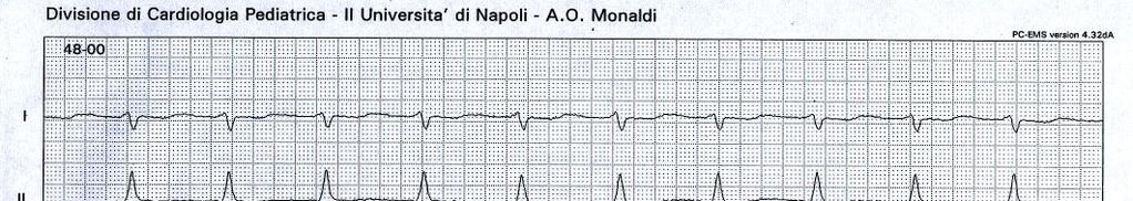 Approccio al paziente con Diagnosi (ECG, Manovre vagali,