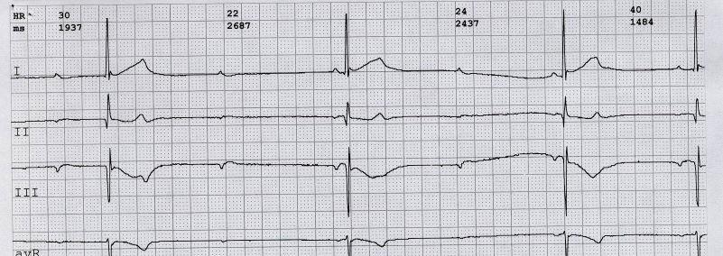 Blocco AV di Terzo Grado Cardiopatia Ischemica Cardiomiopatia Valvulopatia Calcifica Miocardite Collagenopatie Amiloidosi Blocco Congenito Scaricato da www.sunhope.it 31 BAV III Scaricato da www.