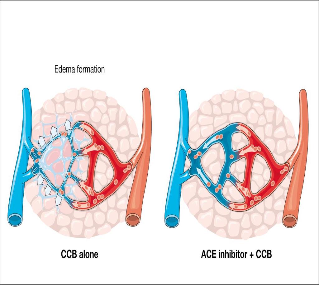 Associazione Ace-inibitori con Ca-Antagonisti Migliore tollerabilità (ridotta incidenza di edemi ai malleoli rispetto al solo Ca ed efficacia/24 ore 130 Media