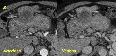 arteriosa ed ipodenso in fase di acquisizione tardiva.