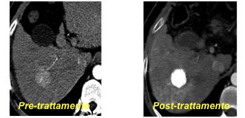 Figu ra 1.C Nell immagine 1.C pre-trattamento si documenta la presenza di HCC del VI segmento, tipicamente ipervascolare in fase arteriosa.