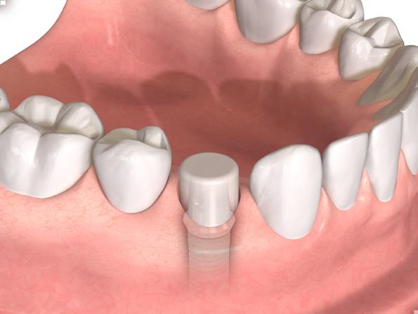 Avvitare nuovamente la vite del pilastro dopo circa 5 minuti con lo stesso valore di torque di 32 Ncm. 4.