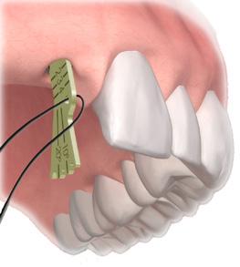 Posizionamento del Pilastro Neoss Access Procedura clinica 1.