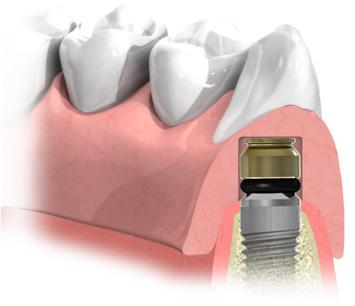 Suggerimento: quando si utilizzano i Pilastri a pallina su Access si faccia riferimento alle istruzioni qui sotto riportate a livello dell impianto.