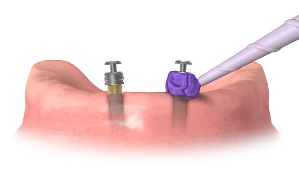 Nuova protesi Procedura Clinica 1.