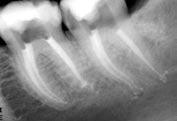 Successo endodontico predicibile: la zona di controllo apicale Figura 18a L otturazione di questo molare superiore dimostra l uniformità delle sagomature sinuose a conicità multiple possibili con il