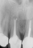 La tecnica del cono di carta. Parte 1ª David B. Rosenberg, DDS Figura 1 La radiografia mostra un incisivo centrale che ha subito un apicectomia.