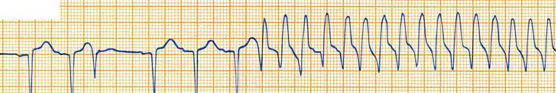 Tachicardie ventricolari QRS