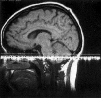 Perdite nella schermatura RF Fase Esempio di